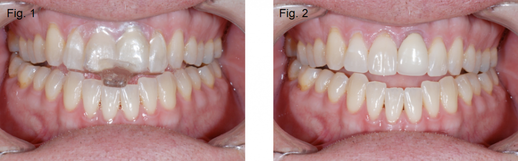 Anterior open bites Figures 1 and 2