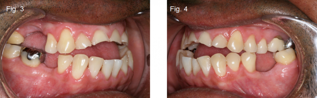 Anterior open bites Figures 3 and 4