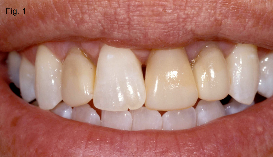 Anterior Bite Planes Part IV Figure 1