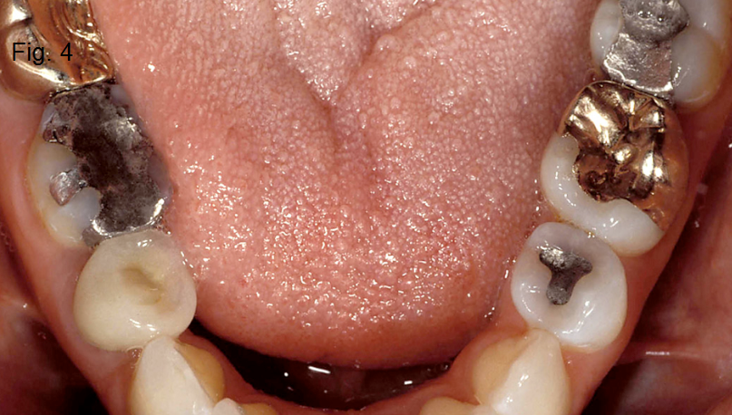 Anterior Bite Planes Part IV Figure 4