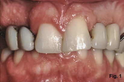 anterior open bites figure 1