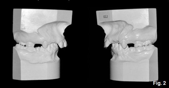 anterior open bites figure 2