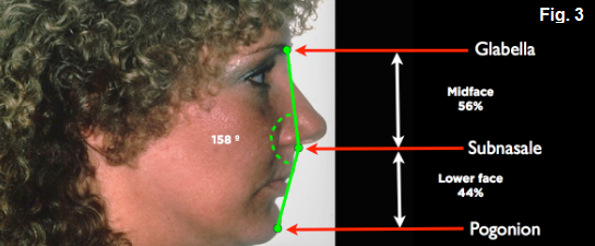 anterior open bites Figure 3