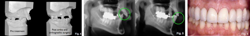 anterior open bites figures 4-6