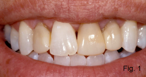 anterior open bite