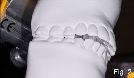 anterior open bite figure 2