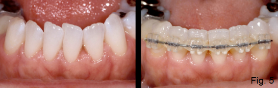 anterior open bite Figure 5