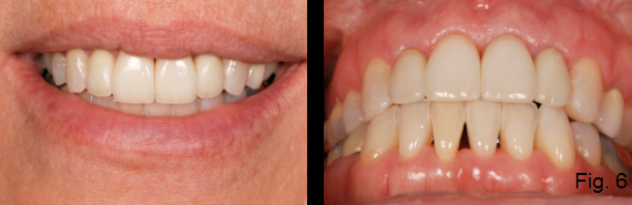 anterior open bite Figure 6