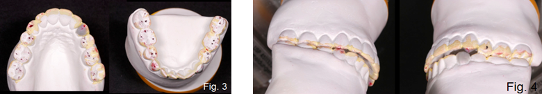 anterior open bite figures 3 and 4