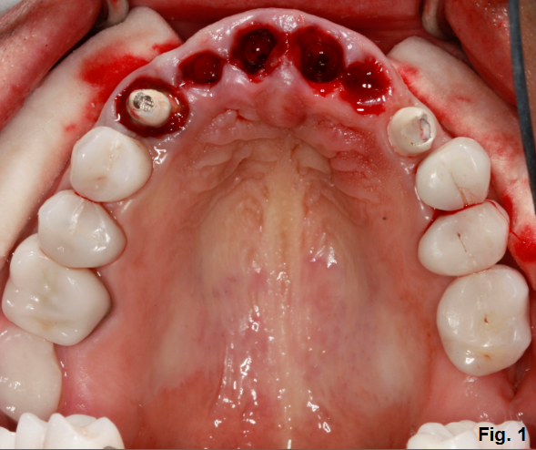 tooth-supported-fixed-bridge-for-missing-maxillary-incisors-spear