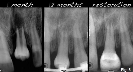 autotransplantation 5