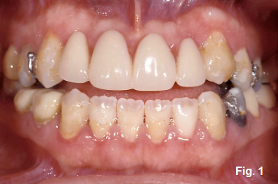 anterior open bites figure 1