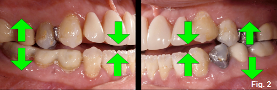 anterior open bites figure 2