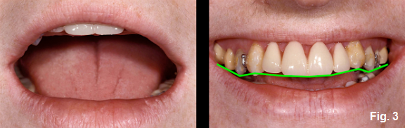 anterior open bites figure 3