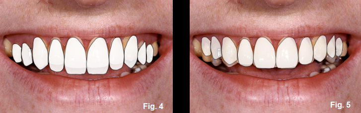 anterior open bites figures 4-5