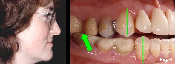 anterior open bites figure 6