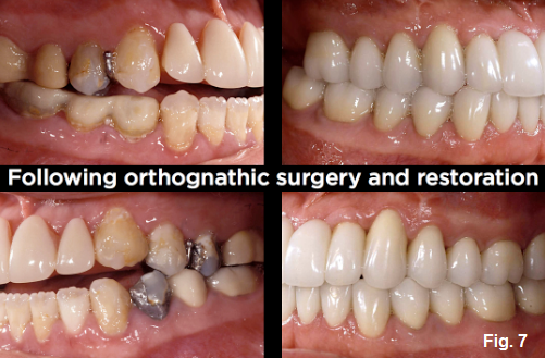 anterior open bites figure 7