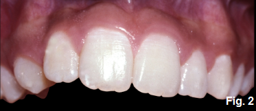 anterior open bites figure 2