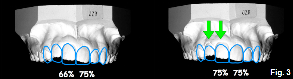 anterior open bites part VII figure 3