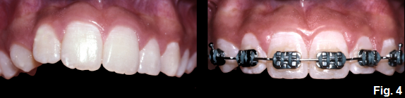 anterior open bites part VII figure 4