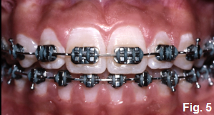 anterior open bites part VII figure 5
