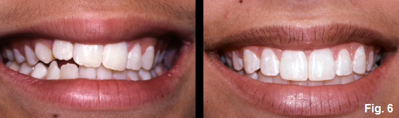anterior open bites part VII figure 6