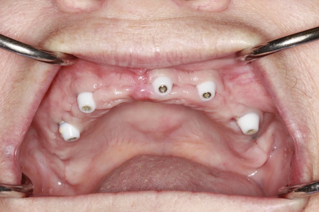 Denture to Interim Hybrid Using the Ministar