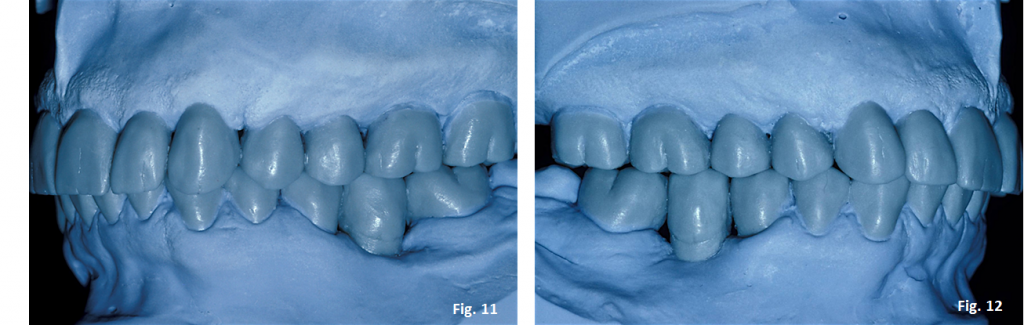 occlusal plane guide