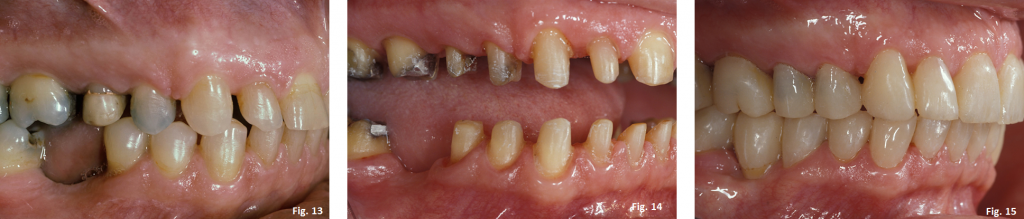 occlusal plane guide