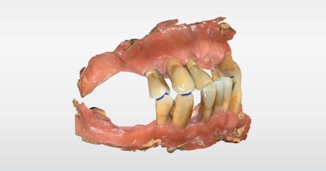 How Digital Technology Ignited My Love of Doing Full Dentures