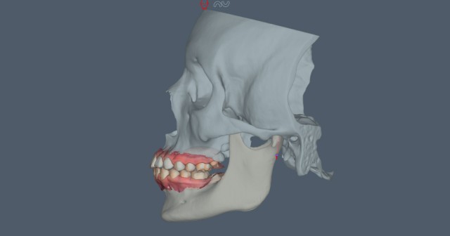 Mandibular Slides and Occlusal Management