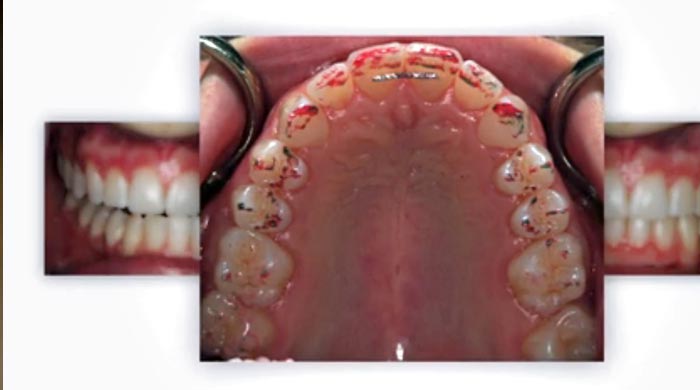 RESTORATIVE DESIGN & PRACTICAL OCCLUSIO… Zirconia: The Ultimate Solution for Complex Cases