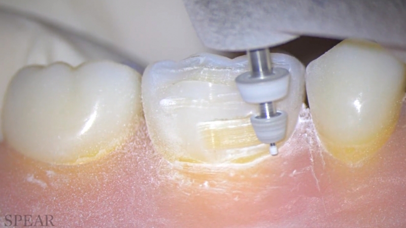 RESTORATIVE DESIGN & PRACTICAL OCCLUSIO… TRUMATCH CMF Patient Specific Plate Contouring | Products